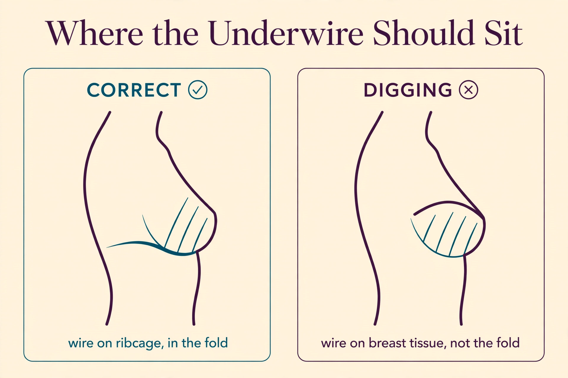 Diagram comparing correct underwire position resting on the ribcage in the inframammary fold versus a digging underwire sitting on breast tissue.
